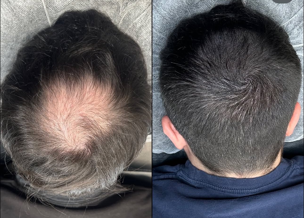 Hair Density SMP Treatment